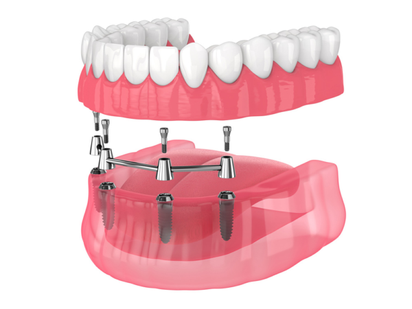 Immediate all-on-x provisional restoration right after surgery