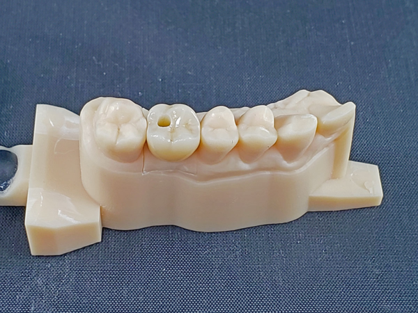 Screw-retained, cement-retained and screw-mentable