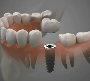 Implant Restoration